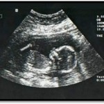 When should I see my baby’s heartbeat on ultrasound?