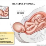 How to Avoid an Induction of Labor – 5 Reasons