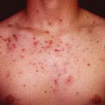 How to Get Rid of Chest Acne: Acne Treatment Forum