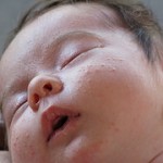 Get Tips For Baby Acne Treatment and Home Remedies