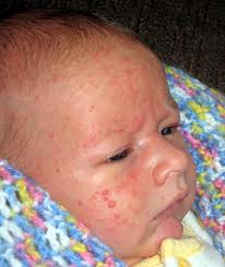 The Causes and Treatment of Baby Pimple