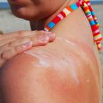 How To Relieve Sunburns with Home Remedies