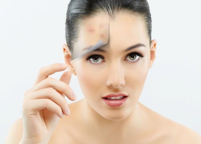 9 Amazing Acne Prone Skin Care Tips