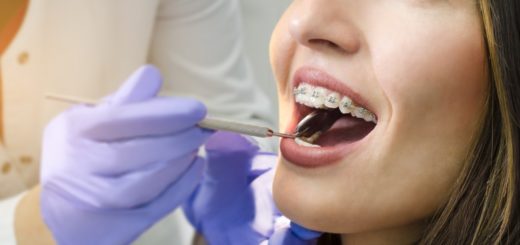 Why Adult Braces are More Convenient and Affordable Today